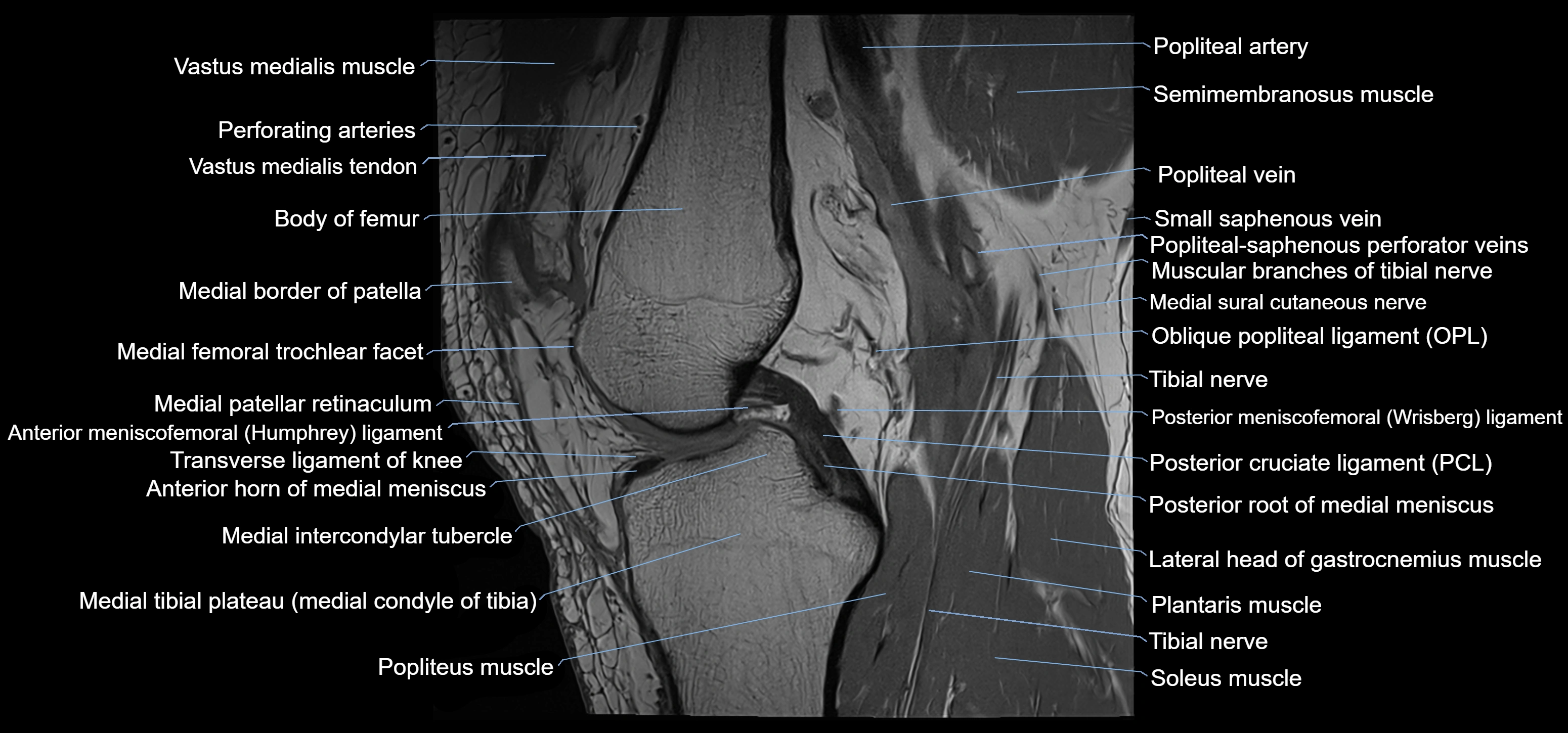 MRI knee sagittal cross sectional anatomy labelled 3T radiology image-00023.webp